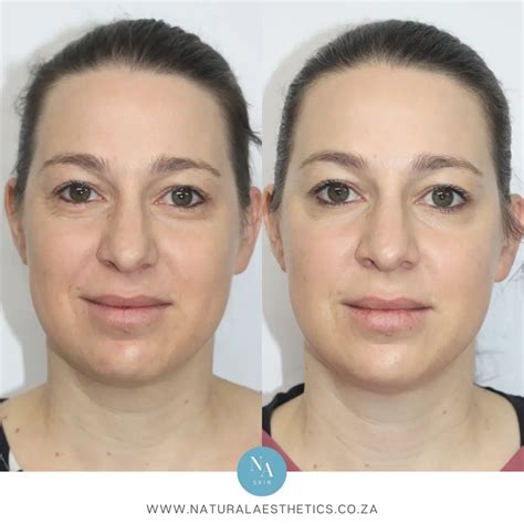 Účinky SkinBooster
