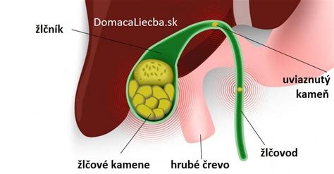 Žlčníkové kamene