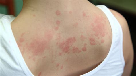 Alergická reakcia
