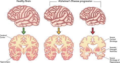 Alzheimer
