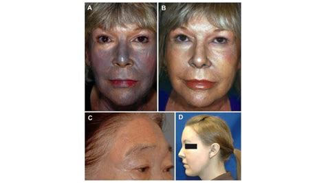 Argyria