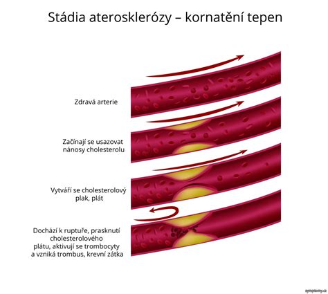 Ateroskleróza