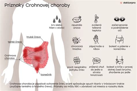 Crohnova choroba