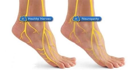 Diabetická neuropatia