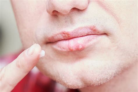 Herpes na pere