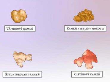 Obličkové kamene
