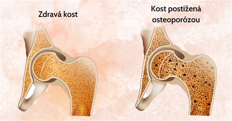 Osteoporóza