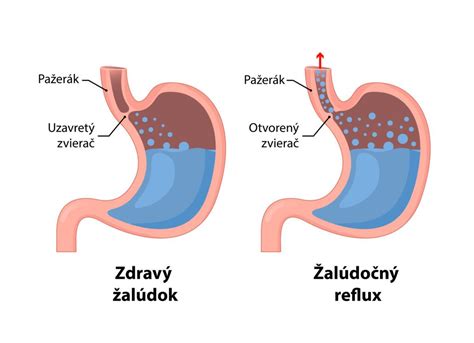 Pálenie záhy