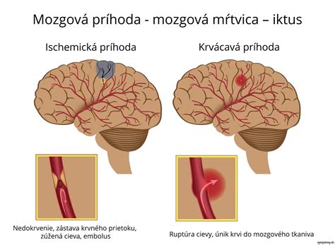 Príznaky mozgovej príhody