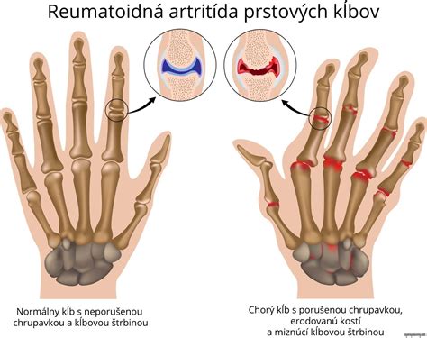 Reumatoidná artritída
