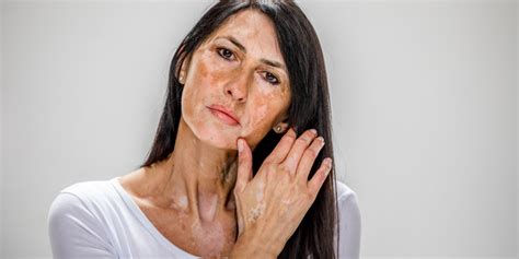 Vitiligo na koži